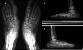 5 / 5 16 мнений. Talipes Equinovarus Treatment In Infants Treated By The Ponseti Method Compared With Posterior Only Release A Mid Childhood Comparison Of Results Sciencedirect