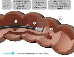 Miwendo: Revolutionising The Detection Of Colorectal Cancer-Projects -  Regional Policy - European Commission