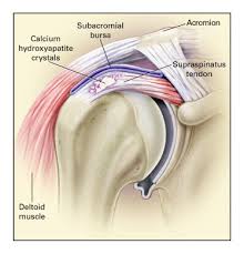 Image result for Rotator Cuff Calcification