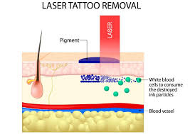 In addition, experts predict that tattoo removal services will increase by 18% each year. Best Laser Tattoo Removal Bellevue Kirkland Gallery Cosmetic Surgery