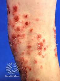 Image result for Impetigo