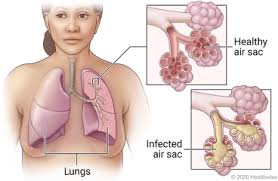 Image result for Pneumonia