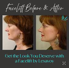 Malcolm A. Lesavoy, MD, FACS