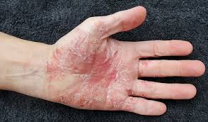 Image result for psoriasis