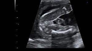 24 Schwangerschaftswoche 24 Ssw Alle Infos Eltern De