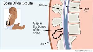 The spine diagram shown below, consists of many bones or vertebrae,soft discs,the spinal cord, and spinal nerves. Spina Bifida Occulta For Parents Nemours Kidshealth