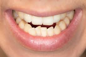 Feb 15, 2019 · from the time that your child first starts to lose their baby teeth you get used to their gappy grin, however it can be the case that a gaps stays a lot longer than expected. Permanent Teeth Growing In Crooked And Discolored What To Dobroke And Chic