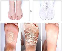 Baby Foot Peel Transformations Your Disgusting New Obsession Baby Feet Peel Foot Peel Baby Feet