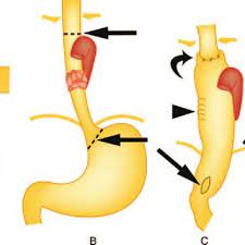Mckeown, md, facs is a board certified plastic surgeon and a fellow of the american college of surgeons. Drawings Illustrate Transthoracic Esophagectomy With A Laparotomy And A Download Scientific Diagram
