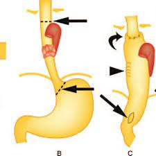 My favorite title is mom. Drawings Illustrate Transthoracic Esophagectomy With A Laparotomy And A Download Scientific Diagram