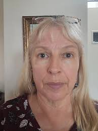 Hi, I am going to get blephs by oculoplastic surgeon and FL/NL by other  doctor. If anyone did like that separately, how far apart did you do? If  FL/NL first, the healing