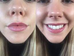 One Writer Tells All About Her Permanent Lip Tattoo Experience With Before And After Photos Aftercare Tips And In 2021 Lip Color Tattoo Lip Liner Tattoo Lip Tattoos
