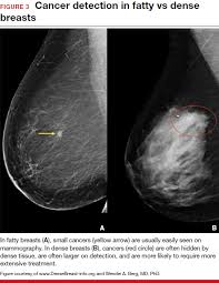 Benefits and risks of harms can include false positive test results, when a doctor sees something that looks like cancer but is not. Breast Density And Optimal Screening For Breast Cancer Mdedge Obgyn