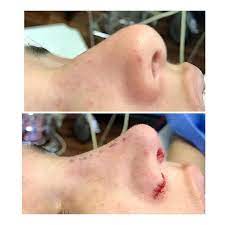 unmittelbar vor und nach der nasenkorrektur um die brucke zu verkleinern und zu heben und zu verfeinern plastische chirurgie nasenkorrektur akne rosacea nase