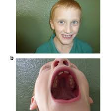 Maybe you would like to learn more about one of these? This 7 Year Old Boy With Fragile X Syndrome Demonstrates A Broad Download Scientific Diagram