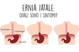 Una dieta sregolata, con mancanza di fibre, può causare questo disturbo. Ernia Iatale Sintomi Cura E Quali Cibi Evitare Farmacie Pezzullo