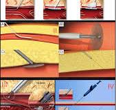 Deployment of the: (I) Angio‐seal closure device, (II ...
