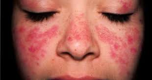 How Lupus Is Influenced By Gut Health Skin Disease Pictures Skin Disorders Lupus Symptoms