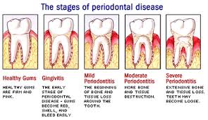 Etiology Of Periodontal Diseases Dental Hygiene