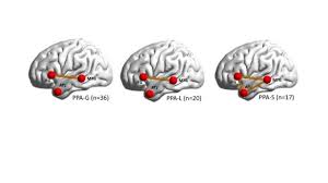 This resource provides information on brain anatomy, brain divisions, cranial nerves, the central nervous system, and the anatomy of the brain is complex due its intricate structure and function. Map Of Broken Brain Networks Shows Why People Lose Speech In Language Based Dementia Northwestern Now