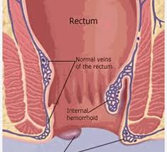 Image result for Hemorrhoid