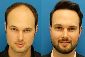 Best Hair Transplant In Turkey Sac Dokulmesi Sac Esmerler