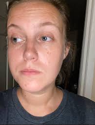 Any short-term natural solutions for sores