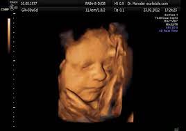 We did not find results for: File Fetal Yawning 4d Ultrasound Ecografia 4d Dr Wolfgang Moroder Theora Ogv Wikimedia Commons