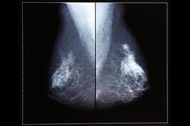 Doctors then perform tests on the surgically removed tissue to determine. Personalized Treatment Is Key For Stage 0 Breast Cancer Cancer Ut Southwestern Medical Center