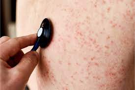 Pinpoint Red Dots On Skin