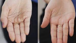 Hair transplant, or restoration surgery, can make the most of the hair you have left. Simple Ways To Detect Hair Fall And Prevent Hair Loss Youtube