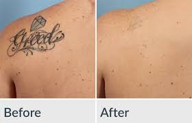 Since tattoo removal is a personal option in most cases and is considered a cosmetic procedure, most insurance carriers will not cover the process unless it is medically necessary. Laser Tattoo Removal Genesis Medspa Jefferson City Missouri