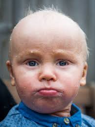 Daniel Maple: Toddler with 'fish scale' skin due to lamellar ichthyosis