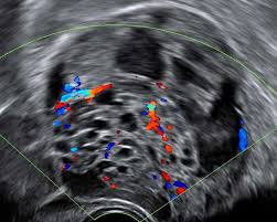 Since ovarian cancer, the stage when cancer has just begun at the ovary and is restricted to the thus ultrasound can miss out on ovarian cancer lumps. Ovarian Cysts And Screening For Ovarian Cancer Ultragyn Ultrasound