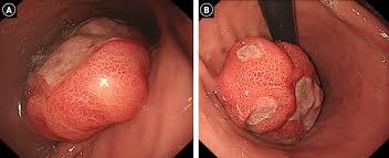 Image result for Leiomyosarcoma