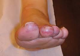Image result for Chilblains