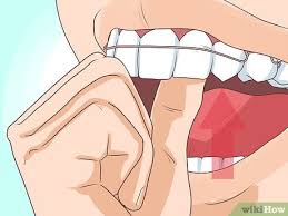 Do you think you need a tune up? How To Put On A Retainer 9 Steps With Pictures Wikihow