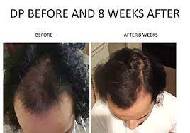Biotin vitamin is also known as vitamin b7 or vitamin h. Amazon Com Spare My Hair Vitamins Vegan Hair Growth Supplement With Biotin Vitamins For Healthy Hair Treatment For Men Women Visible Results In 1 Month Longer Stronger Hair Gluten Free