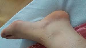 Dabei haben sie die möglichkeit, ihre symptome genau zu schildern. Ich Habe Mein Fuss Umgeknickt Was Soll Ich Jetzt Machen Gesundheit Fusse