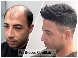 Chute de cheveux chez l'homme : Hb Extension Vente En Ligne En Algerie Extensions De Cheveux En Algerie Vente Avec Livraison