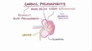 Image result for Acute Pyelonephritis