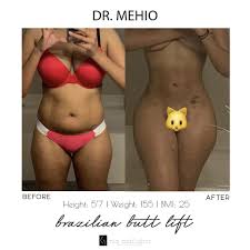 I only got breast augmentation with dr.x. Mia Aesthetics Caption This Transformation Below By Drmehio Mia Miababe Miaaesthetics Bbl Drmehio Bodygoals Snatched Facebook