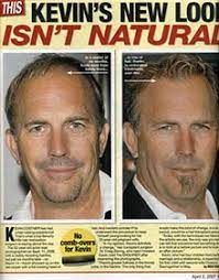 Hair loss affects the vast majority of people and the hair transplant industry is one of the fastest growing cosmetic surgery industries in the world. Celebrity Hair Transplant A Hot Topic