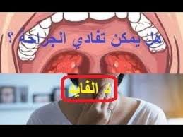 التهاب اللوزتين هل يمكن تفادي الجراحة و إستئصال اللوزتين Blog Posts Blog