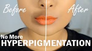 Women are more likely to get wrinkles in the area thanks to the very structure of the skin there. Hide Darkness Around Mouth Using Blush The Correct Way To Color Correct Mrjovitageorge Extrashade