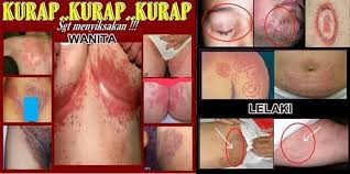 Sungguh tak sangka khasiat daun kaduk boleh menurunkan via www.motif.my. Ubat Mujarab Kurap Dan Gatal Home Facebook