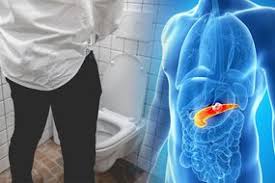 Once patients are in this stage, the cancer has spread to other organs here are eight possible signs of pancreatic cancer — including some that your doctor probably never told you about. Pancreatic Cancer Symptoms Signs In Your Poo That Could Signal The Deadly Disease Express Co Uk