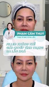 Với quan điểm của Bác sĩ Thúy, Filler không hề xấu, tuy nhiên với những chị  em mong muốn một giải pháp trẻ hóa tự nhiên, lâu dài và bền vững thì Filler  chưa thực sự là lựa chọn đúng., Vì vậy, đối với ...