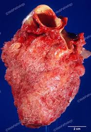 Image result for Pericarditis