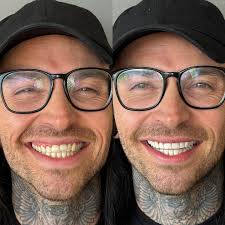 It was such a privilege last week to have @nathan_aurora travel out from  California to see me to work some magic with his smile. One morning in the  office and we were